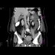 Acute necrosing pancreatitis: CT - Computed tomography